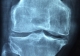 CSIRO trial to help recovery from total knee replacement